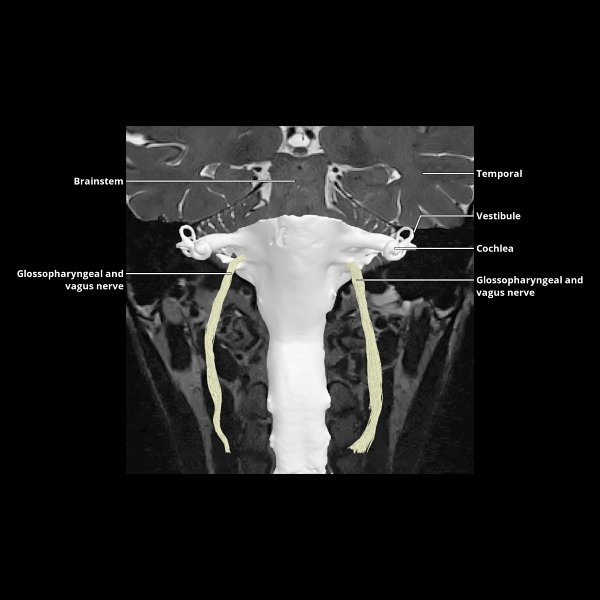 Vagus Nerve CNX Radiology Key