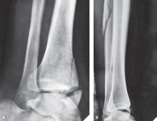 Abnormalities Of The Superficial Peroneal Nerve At The Ankle
