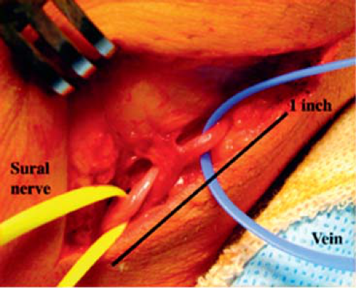 Plantar Fasciitis and Other Abnormalities of the Plantar Fascia