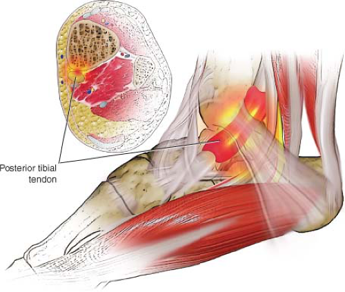 Posterior Tibialis Tendinitis And Other Abnormalities Of The Posterior