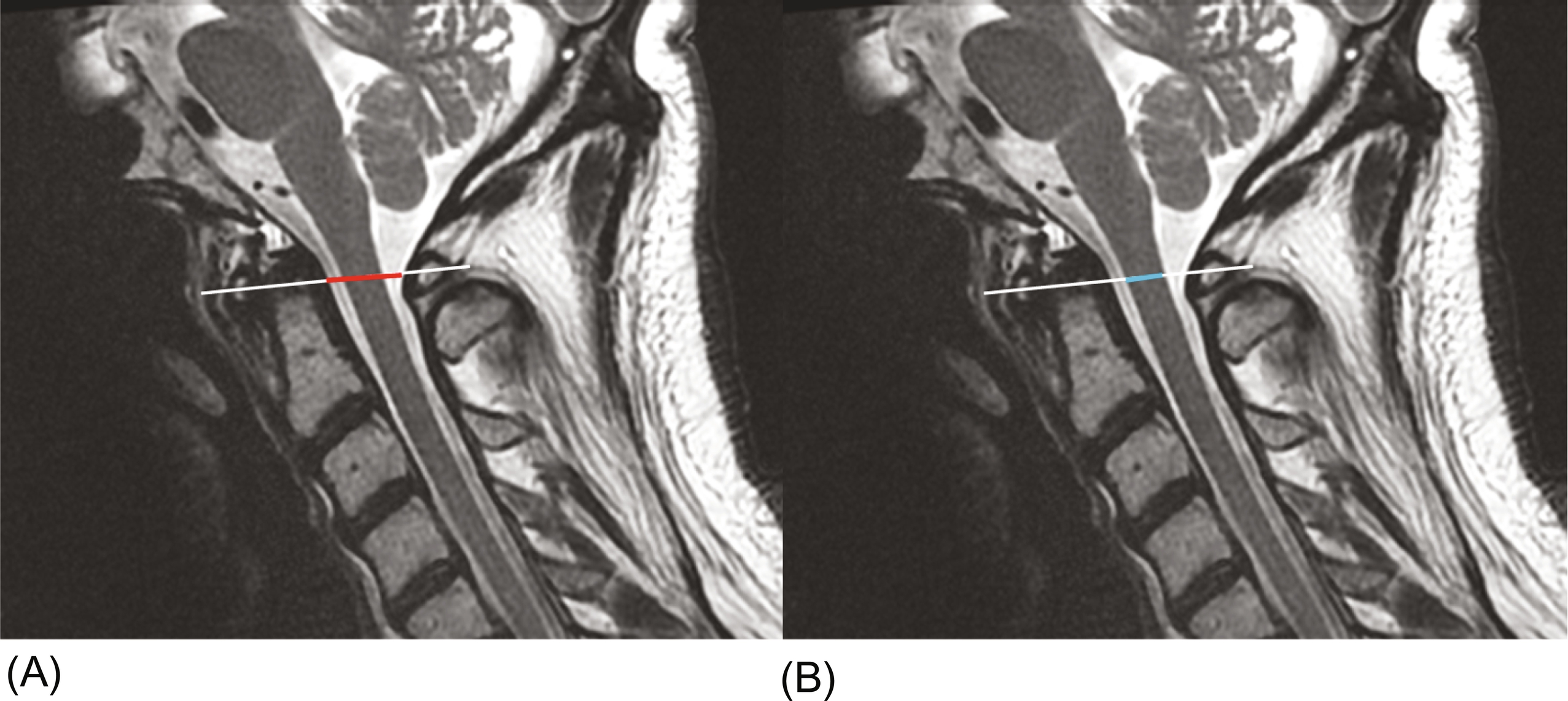 Upper Cervical Spine Mri Radiology Key