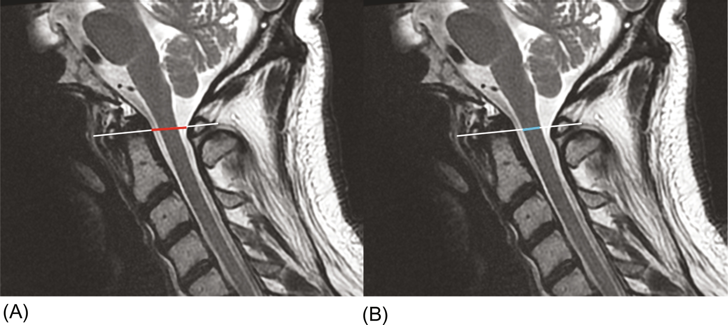 Upper Cervical Spine Mri Radiology Key Free Hot Nude Porn Pic Gallery