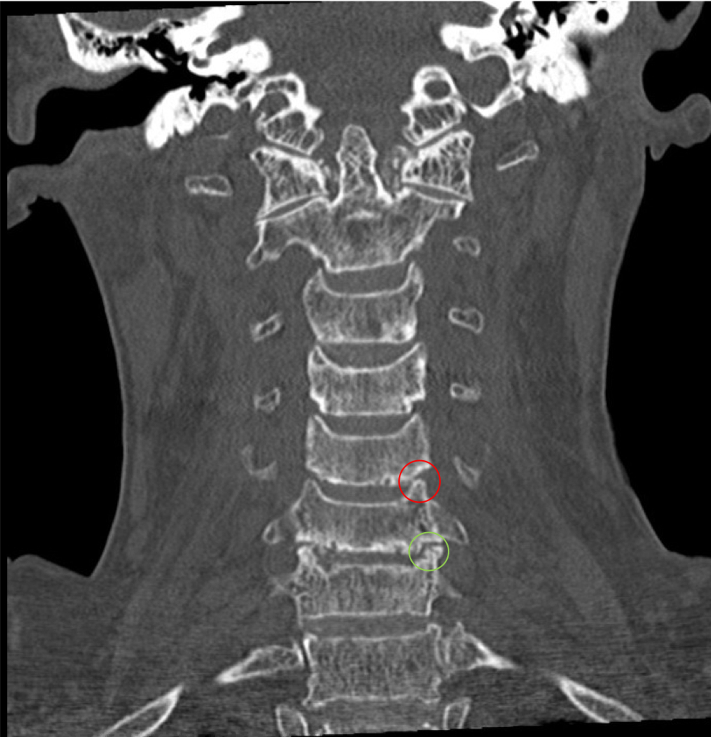 Cervical spine CT scan