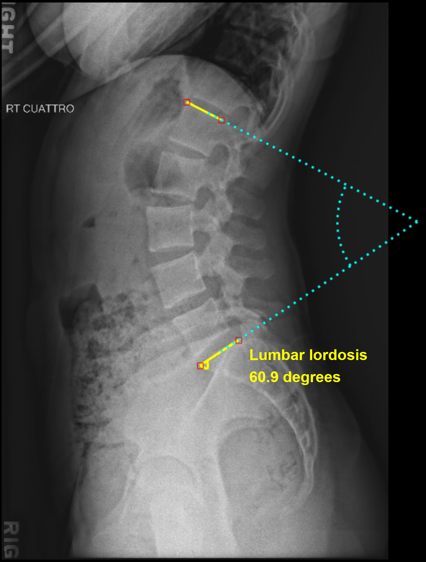 oblique view of lumbar spine