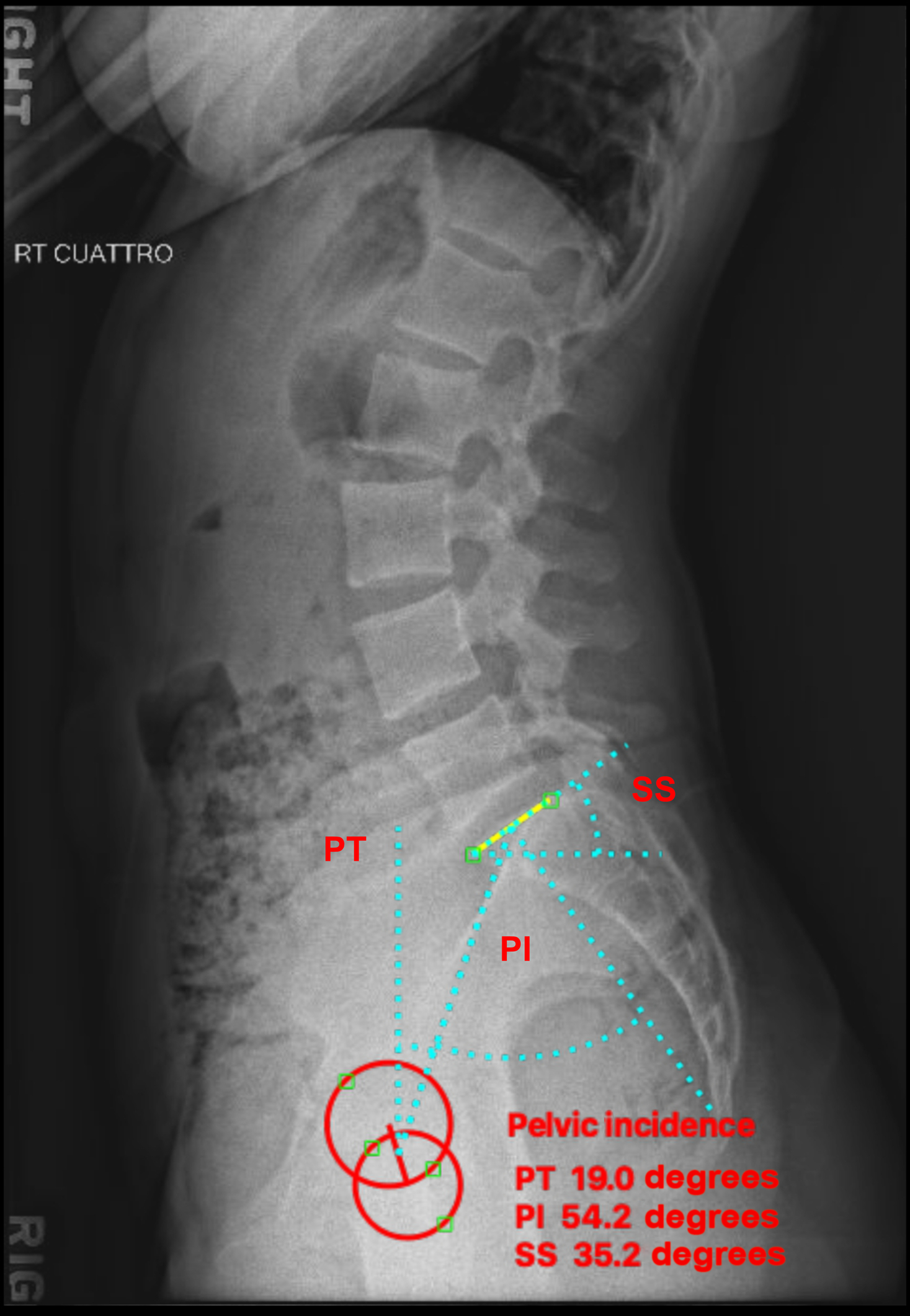 lumbar vertebrae anatomy xray