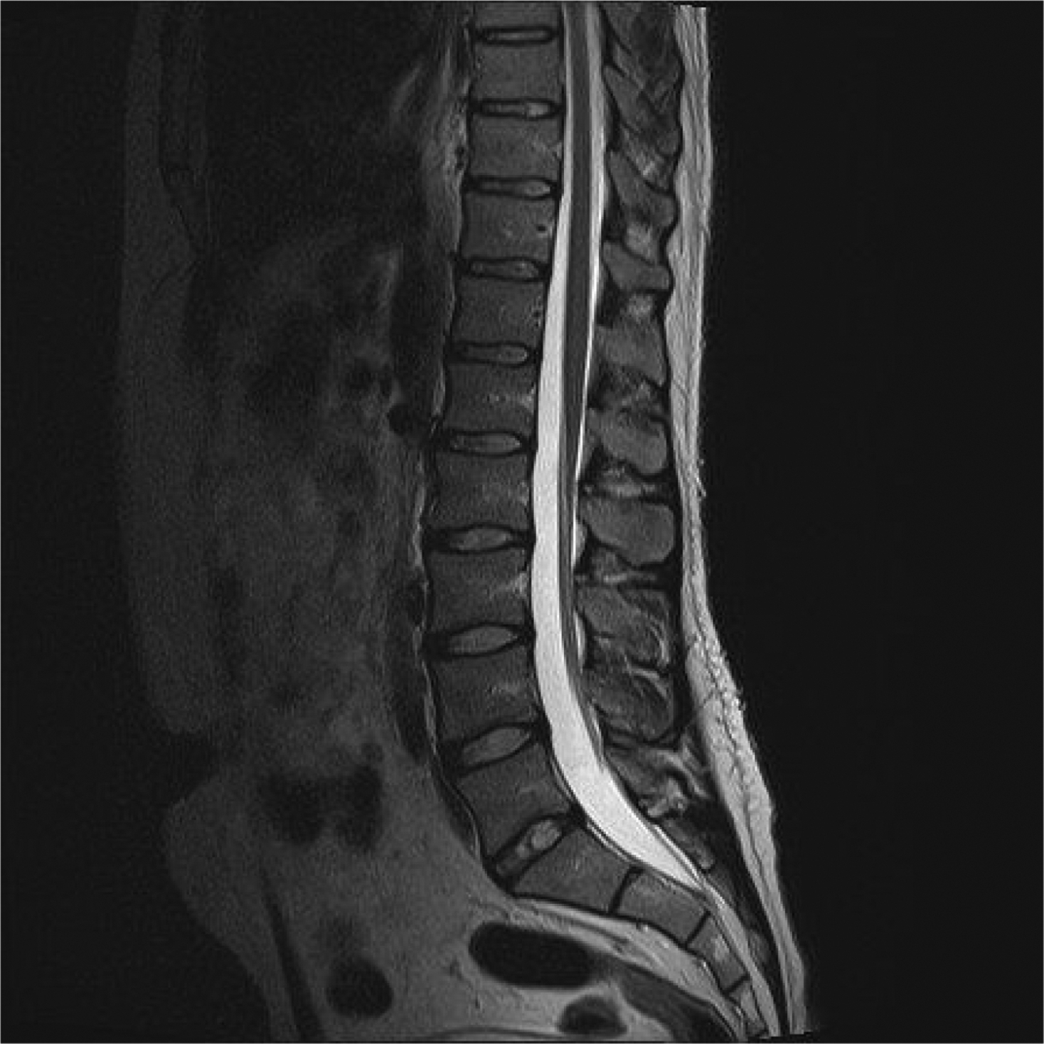 Mri Lumbar Spine Scan Sagittal View Lumbosacral Spine Has Straightening Sexiezpix Web Porn