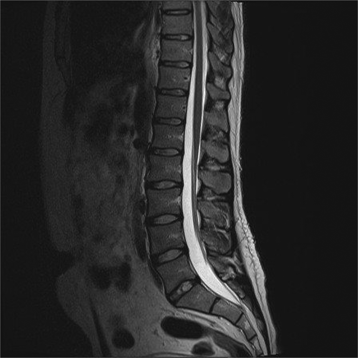 lumbar spine mri labeled