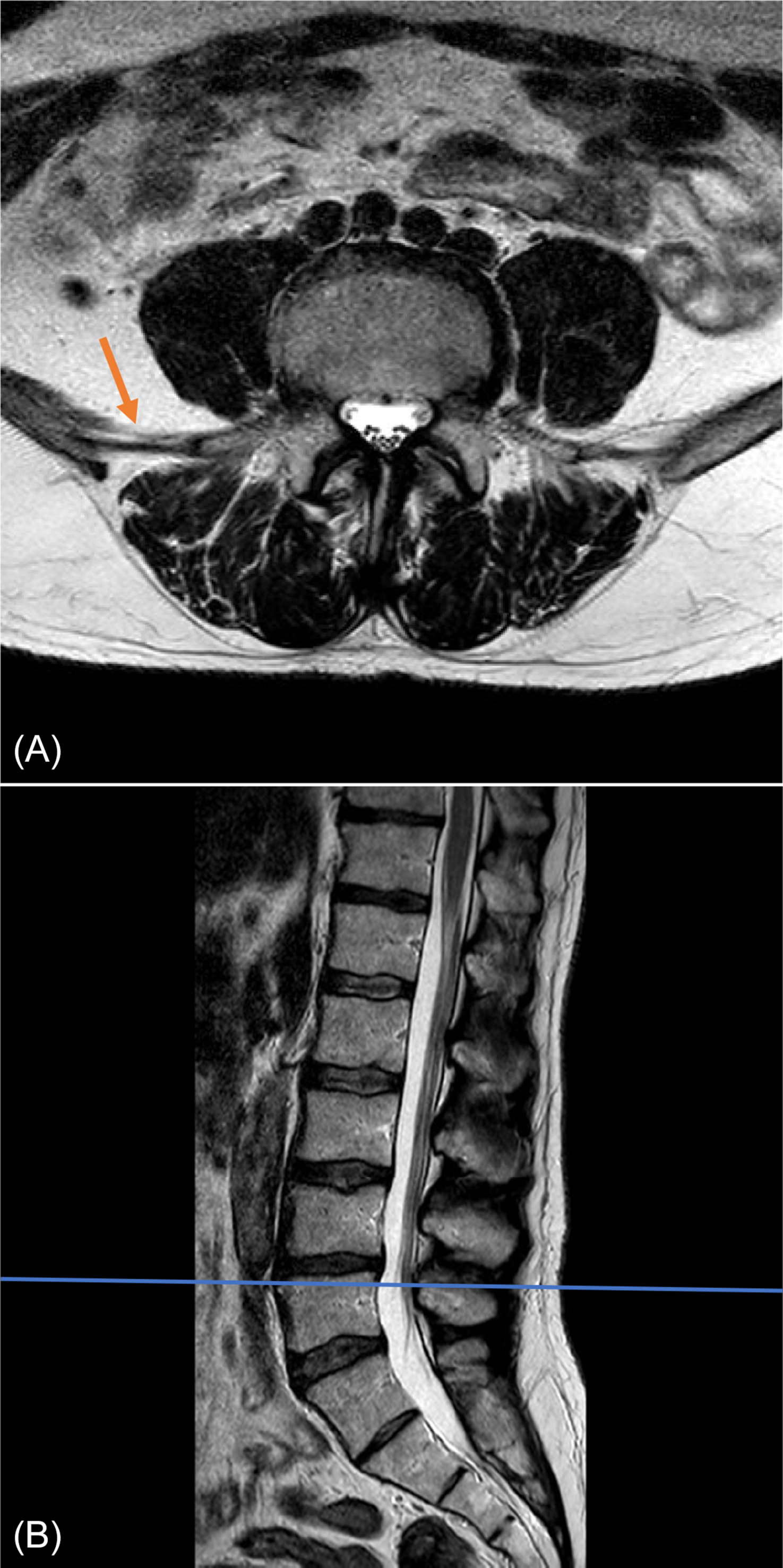 Magnetic resonance imaging scan of dorso-lumbar spine. T2 weighted