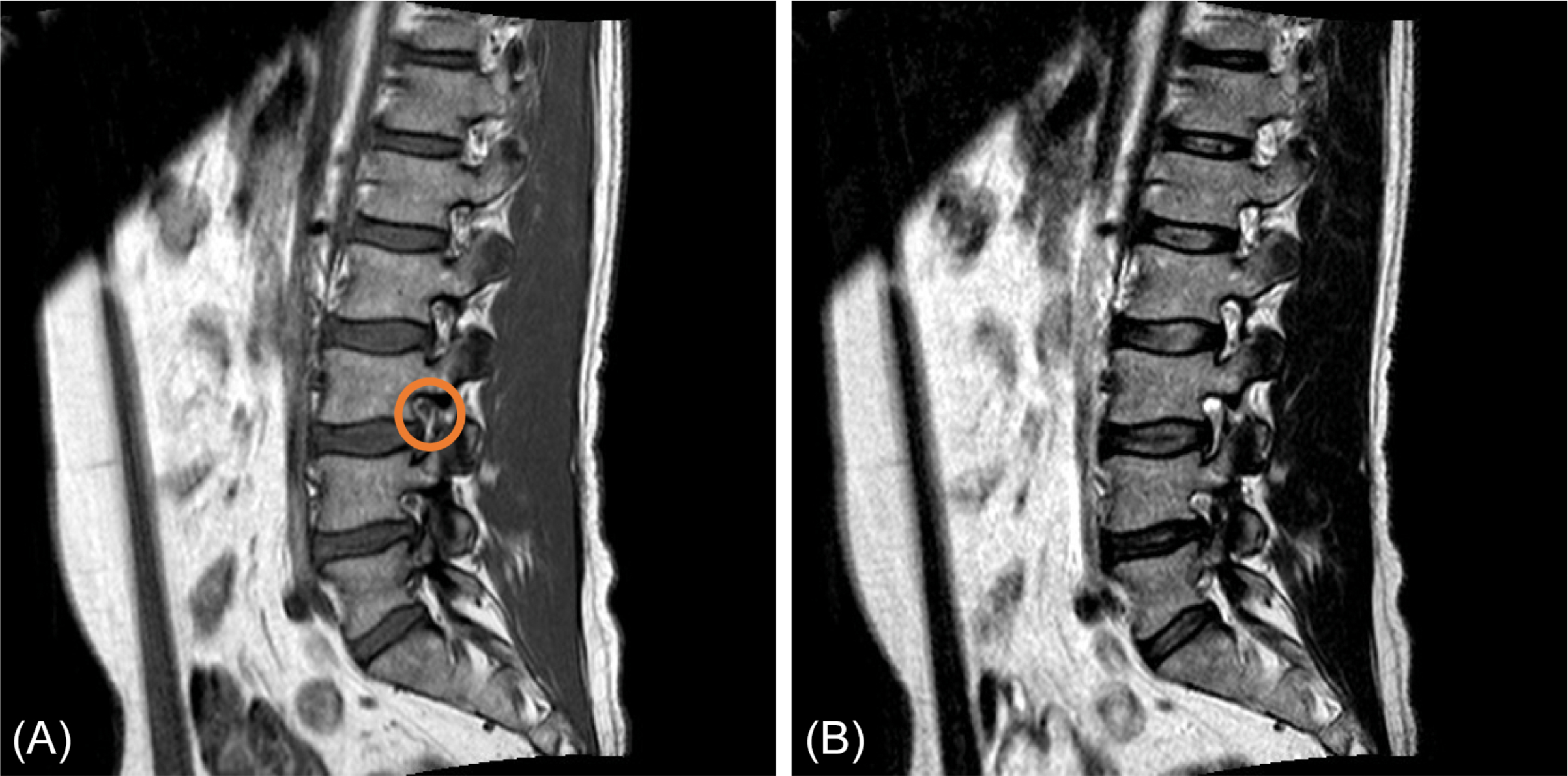 Lumbar Spine Mri Labeled