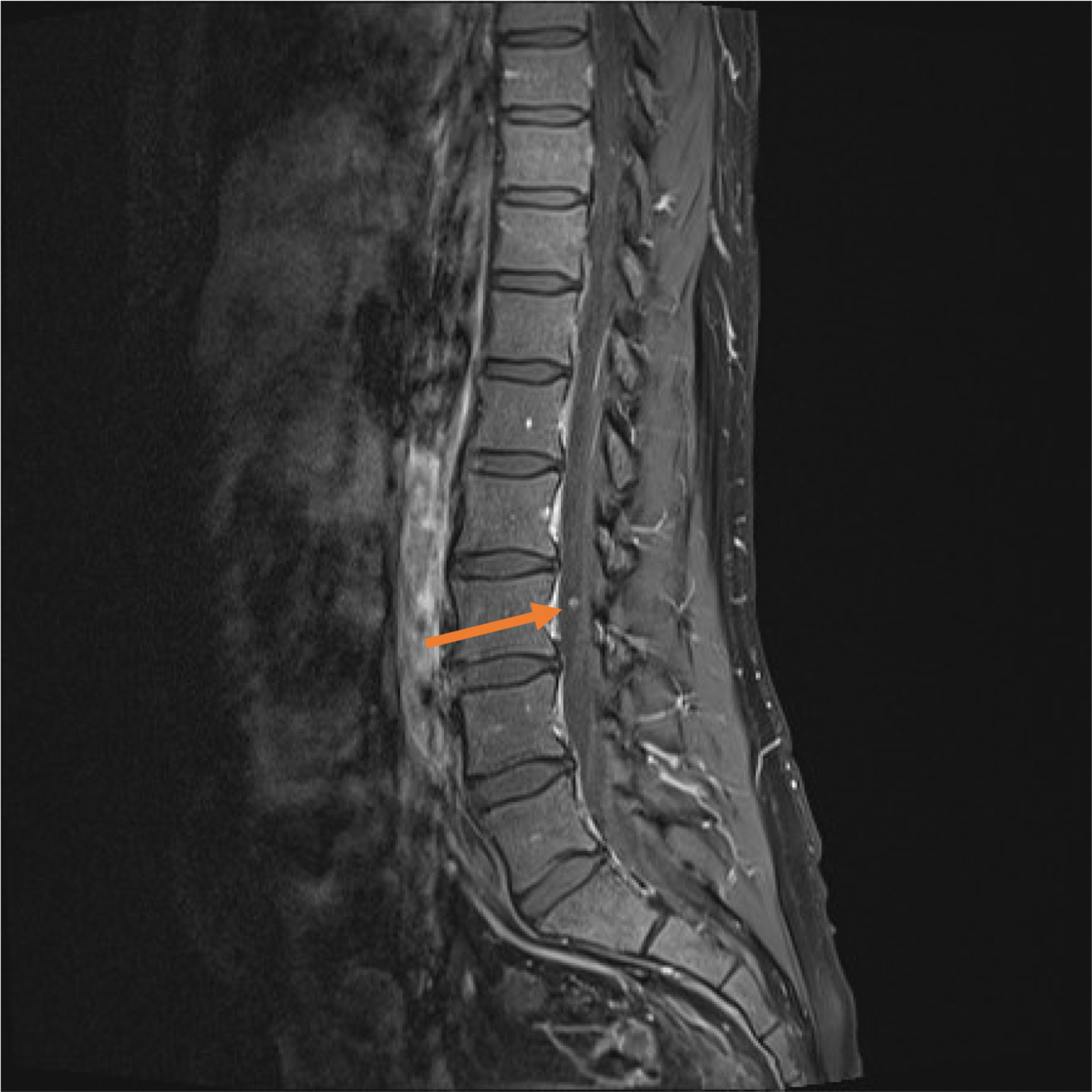 Sagittal T2 image of dorso-lumbar spine shows a hyper-intense
