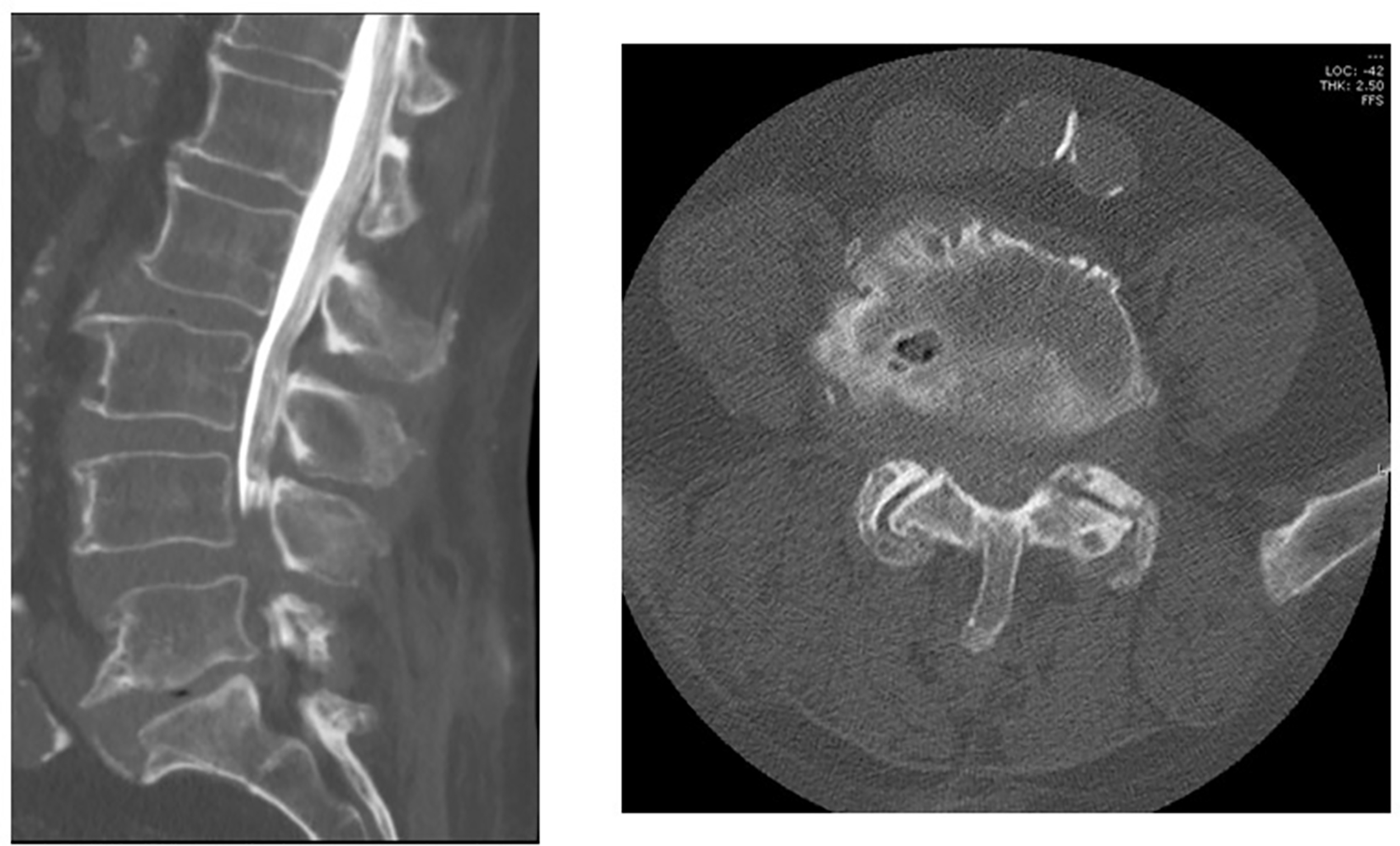 CT scan of lumbar spine - DocCheck