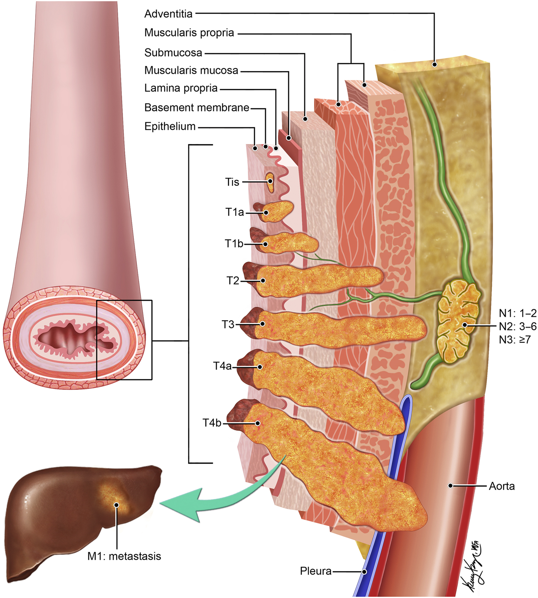 esophageal-cancer-radiology-key