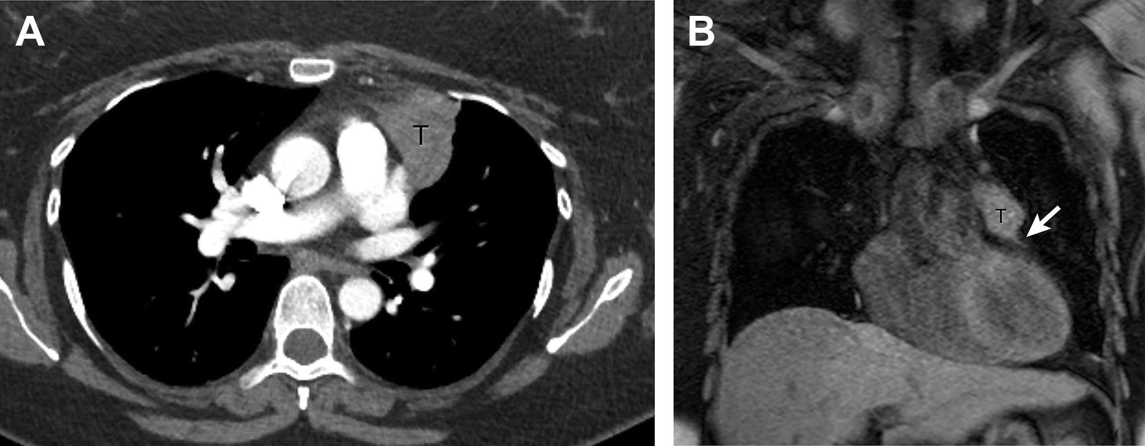 Thymic Epithelial Neoplasms Radiology Key