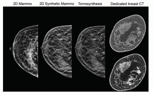 This mammograph provides a 2-dimensional rendering of the mean breast