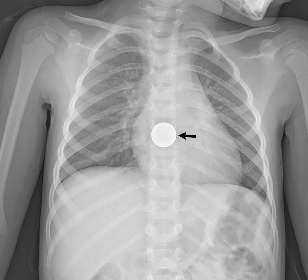 You ate what? Swallowed foreign bodies | Radiology Key