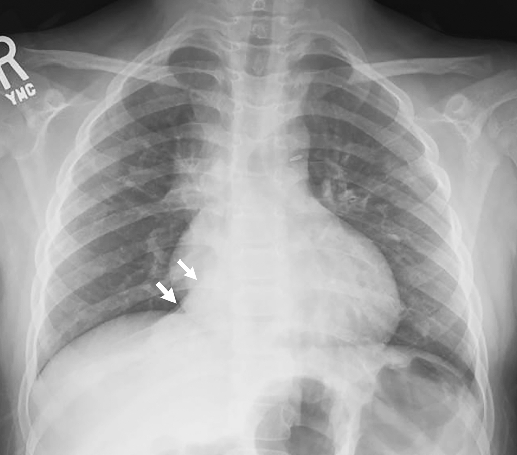 pneumothorax vs atelectasis