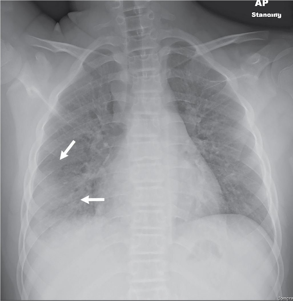 mycoplasma pneumonia xray