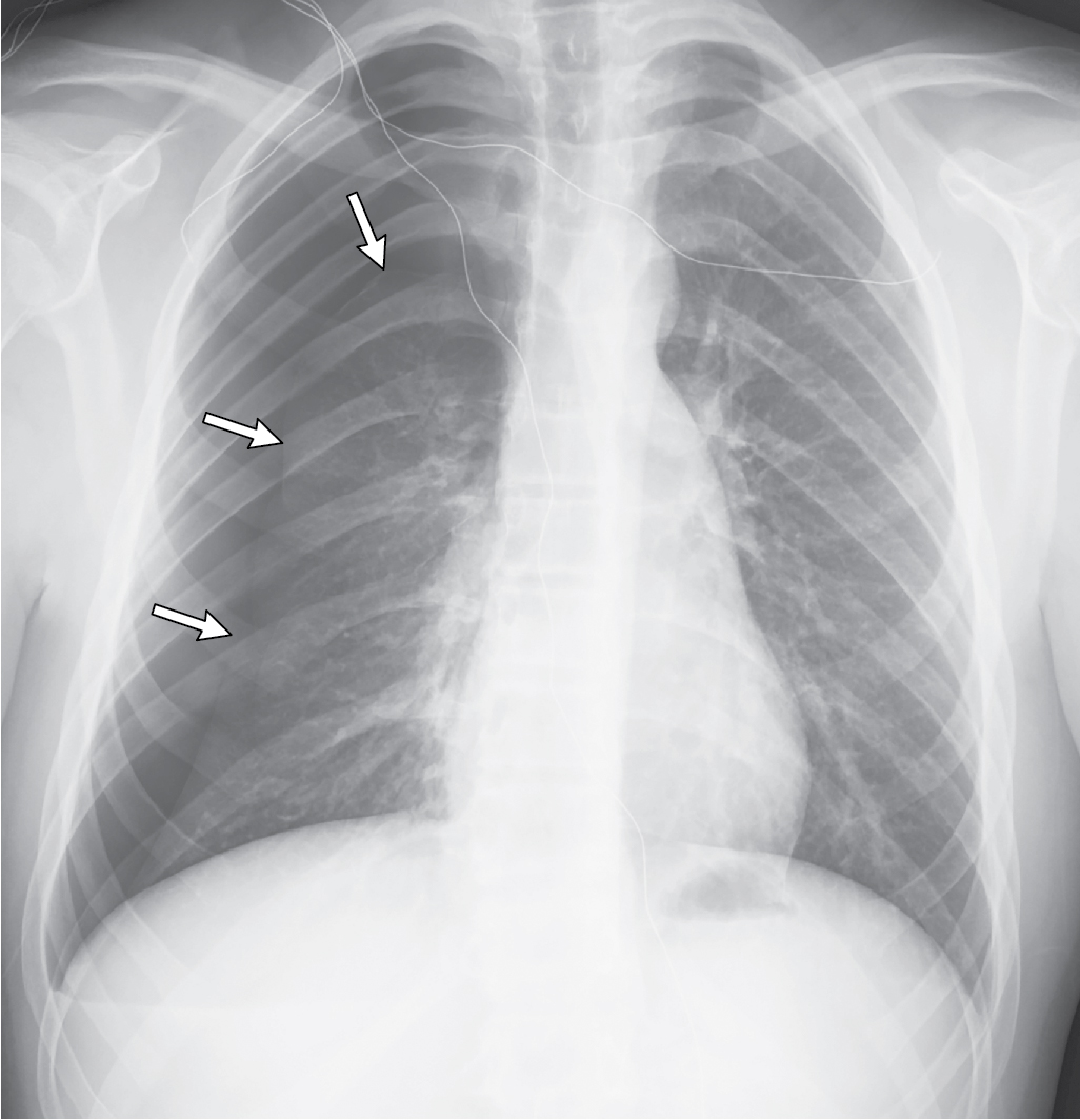 Where’s the air? Pneumothorax Radiology Key