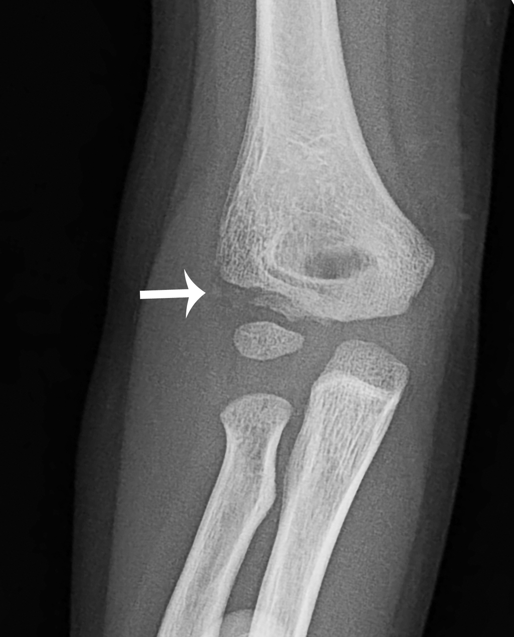 lateral condyle fx humerus closed