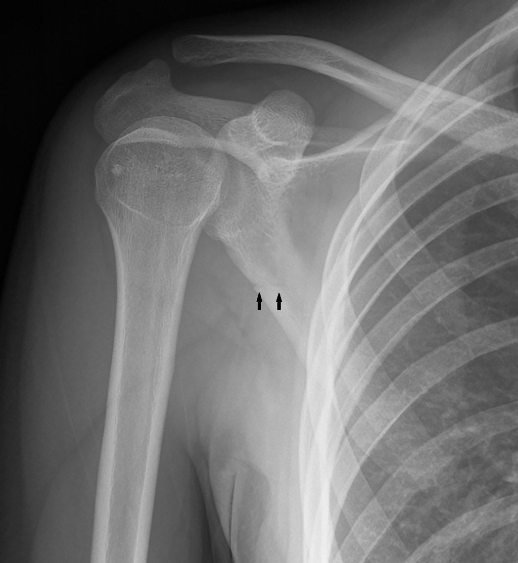 Rough trip Scapula fracture Radiology Key