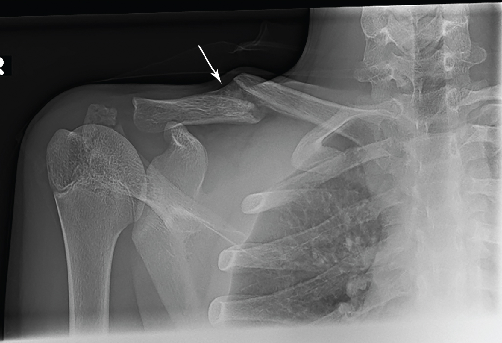 In pieces: Clavicle fracture | Radiology Key