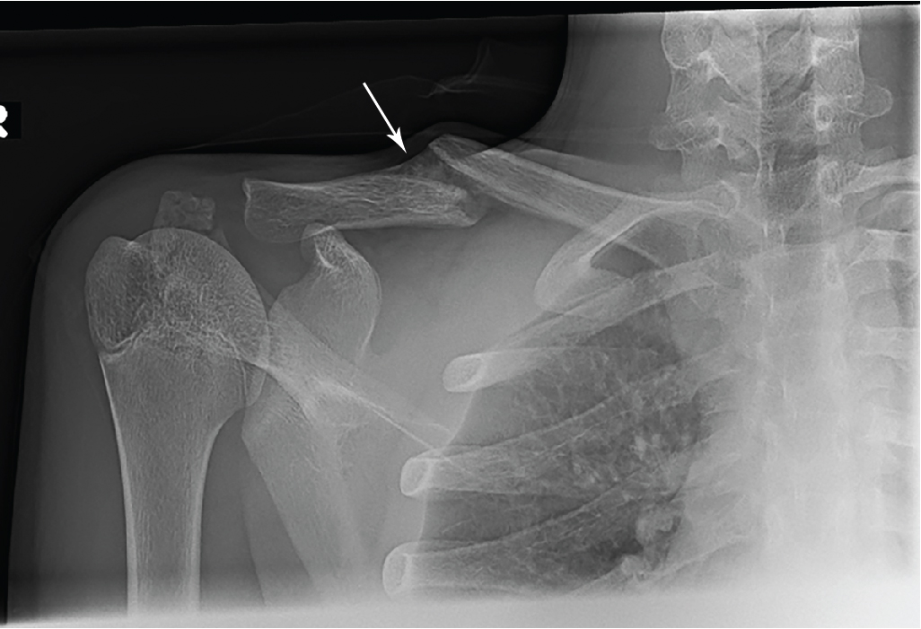 In pieces Clavicle fracture Radiology Key