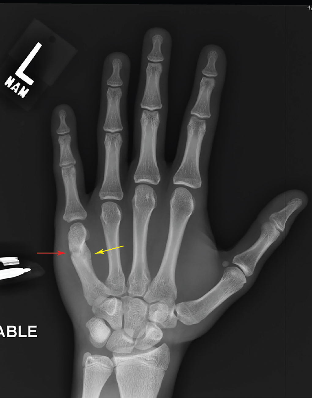 icd 10 code for fifth metacarpal fracture left hand