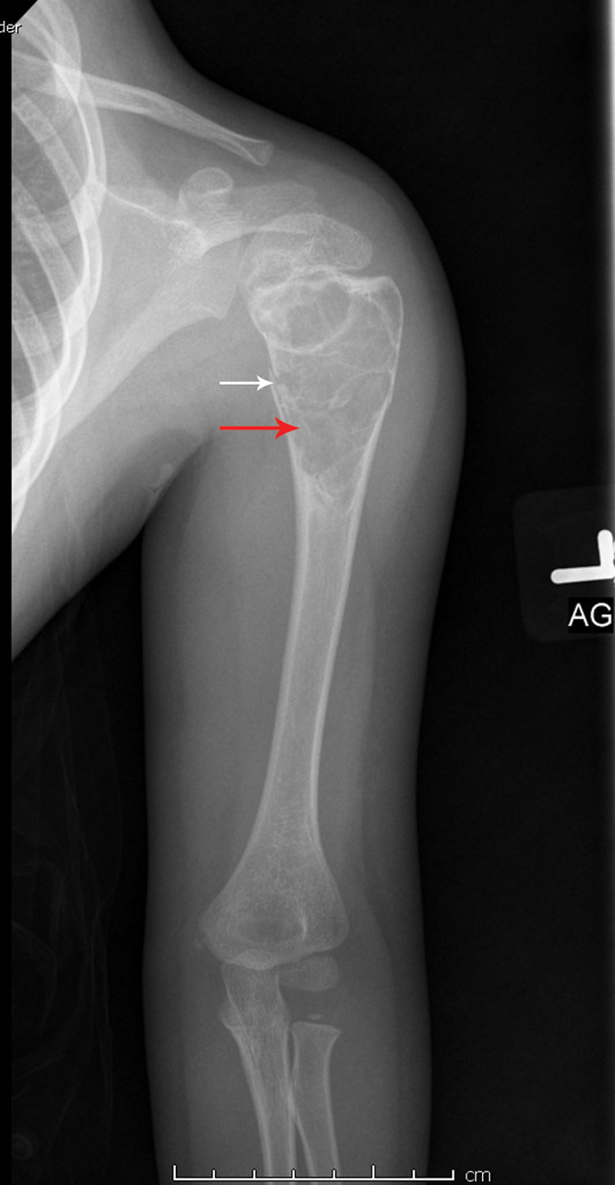 What is this? Bone cyst | Radiology Key