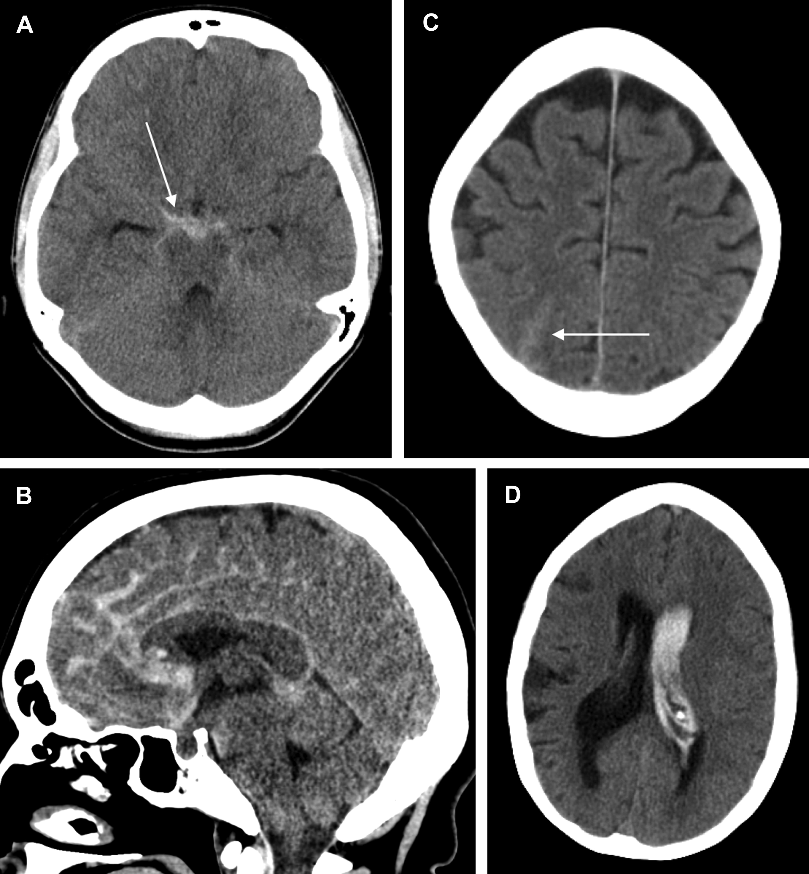 Subarachnoid Hemorrhage Of Unknown Cause Radiology Key