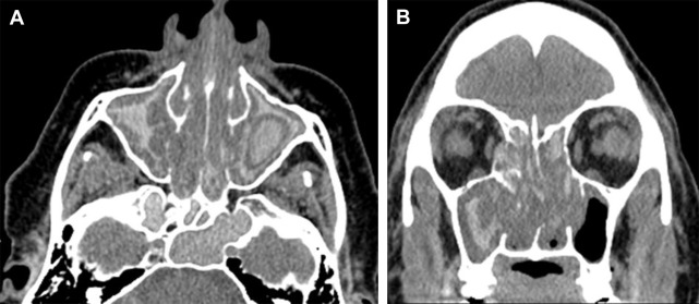 Allergic store fungal sinusitis