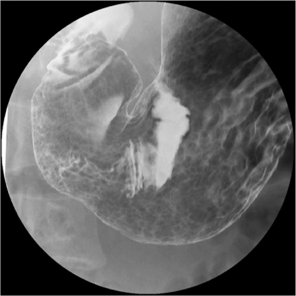 gastric-wall-thickening-masses-radiology-key