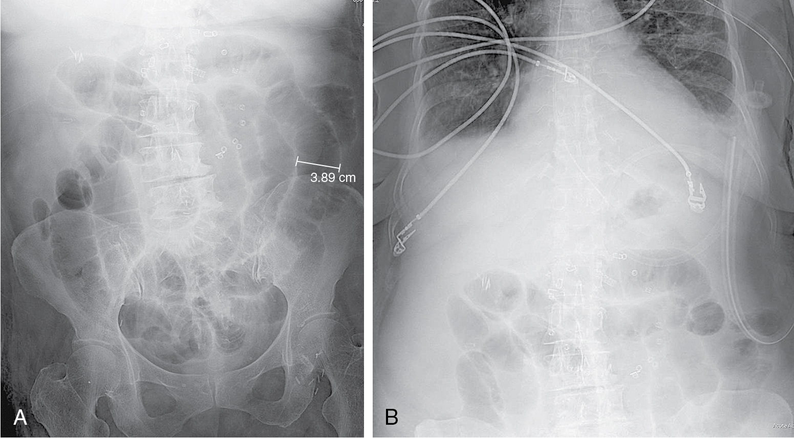 small-bowel-obstruction-radiology-key