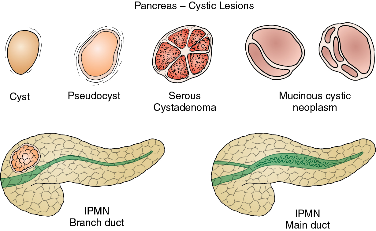 cystic-pancreatic-lesions-radiology-key