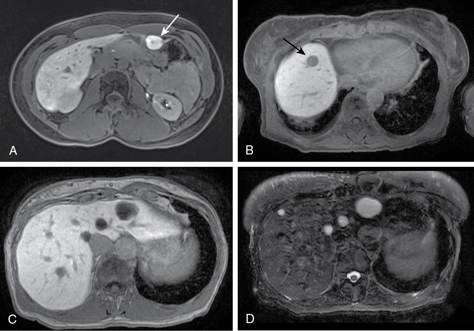 What Is The Most Common Cause For Focal Liver Lesions