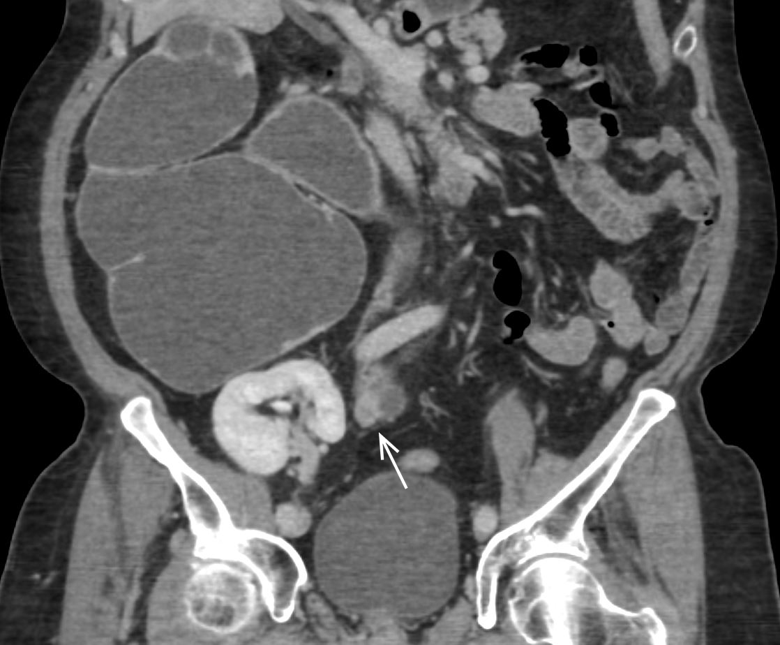 Urinary Tract Obstruction Radiology Key