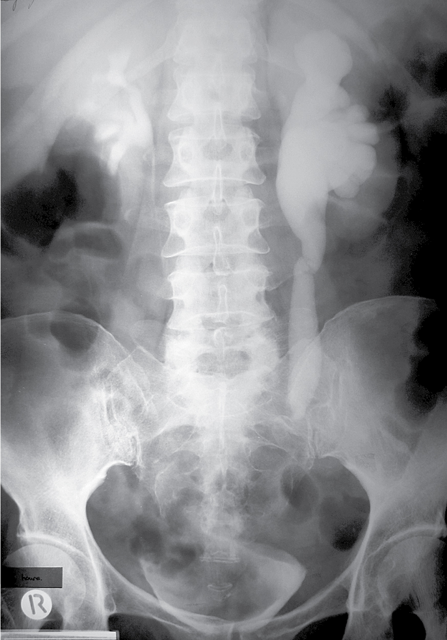 Urinary Tract Obstruction Radiology Key