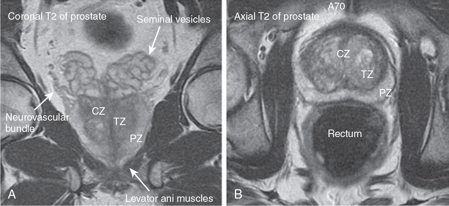 Prostate Gland Anatomy Mri
