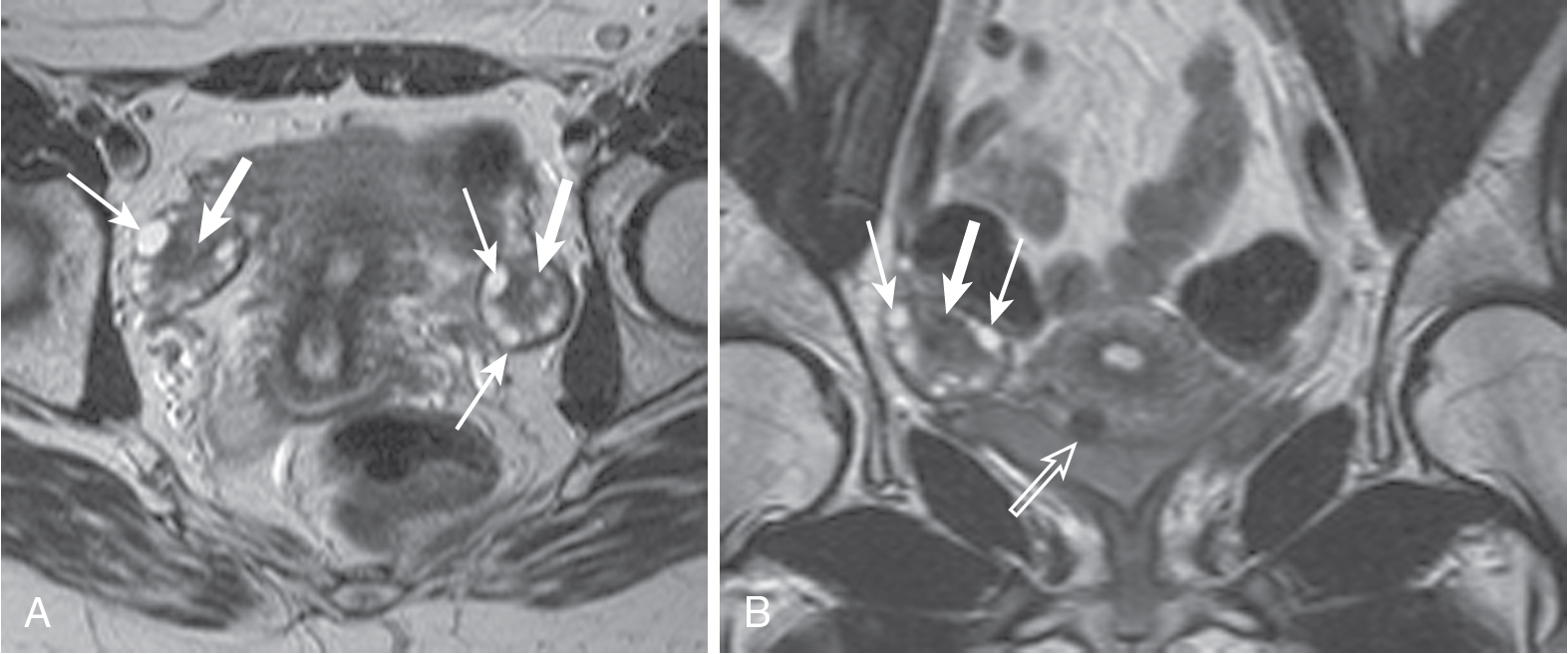 cystic-adnexal-lesions-radiology-key