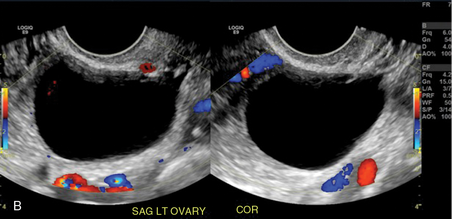 cystic-adnexal-lesions-radiology-key-free-hot-nude-porn-pic-gallery