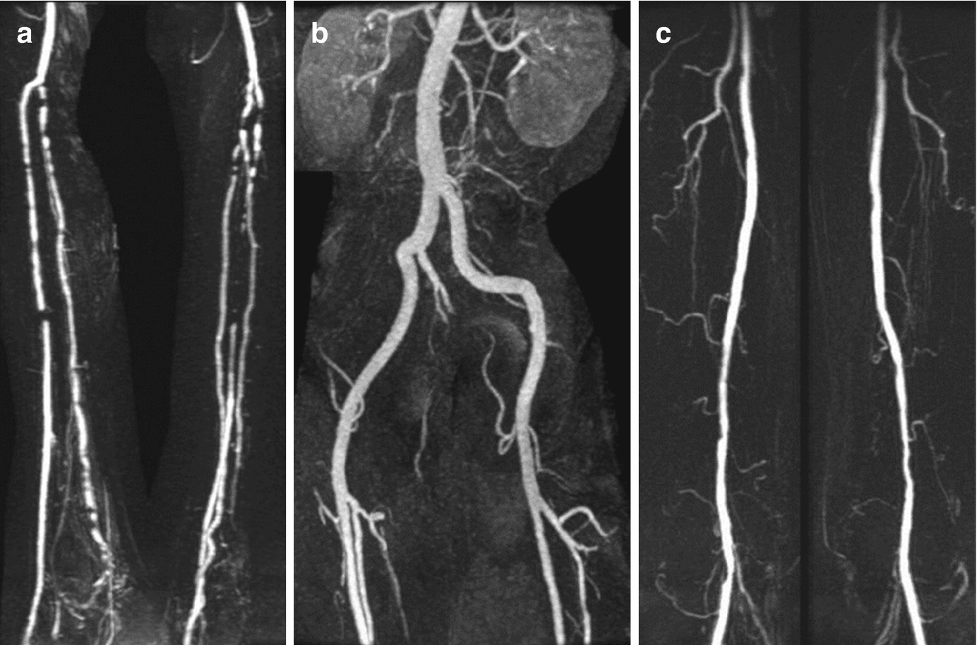 Imaging Approaches And Challenges In The Assessment Of Peripheral 