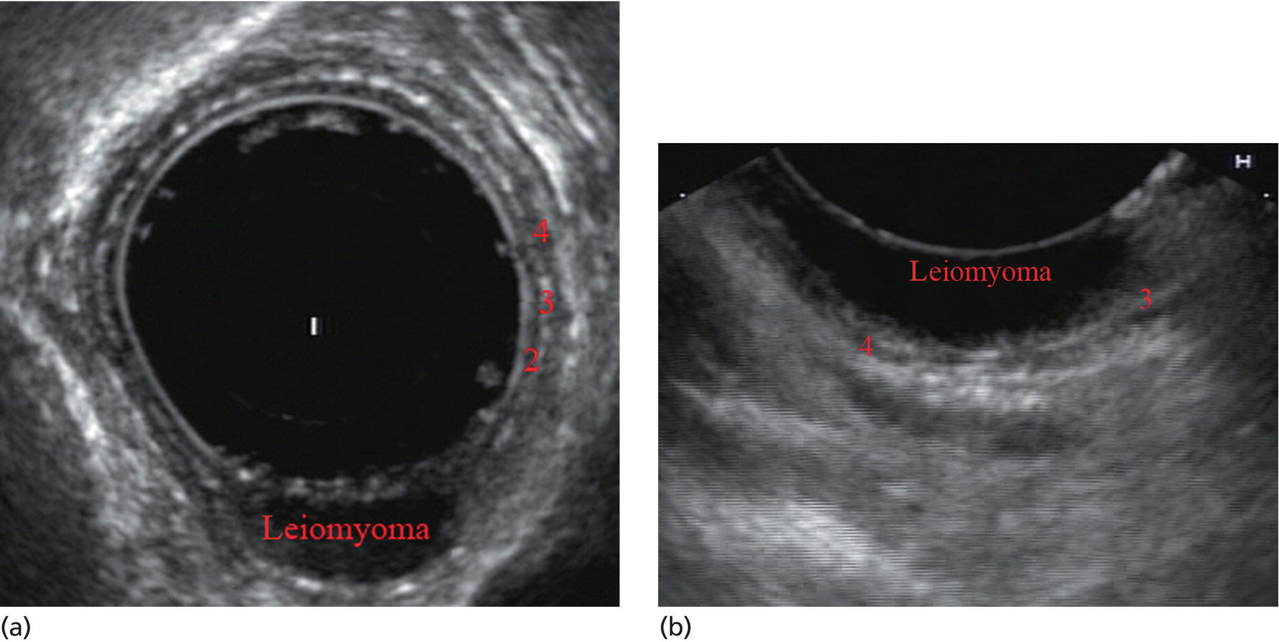 PhotoS depict (a) Radial array image of esophageal wall with small echolayer II leiomyoma. (b) Linear array image of esophageal wall with small echolayer II leiomyoma.