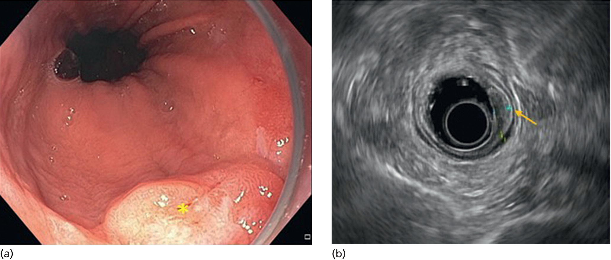 Photos depict (a) T1b adenocarcinoma at the gastroesophageal junction with central depression shown by asterisk. (b) EUS image showing submucosal invasion but no involvement of muscularis propria shown by yellow arrow.