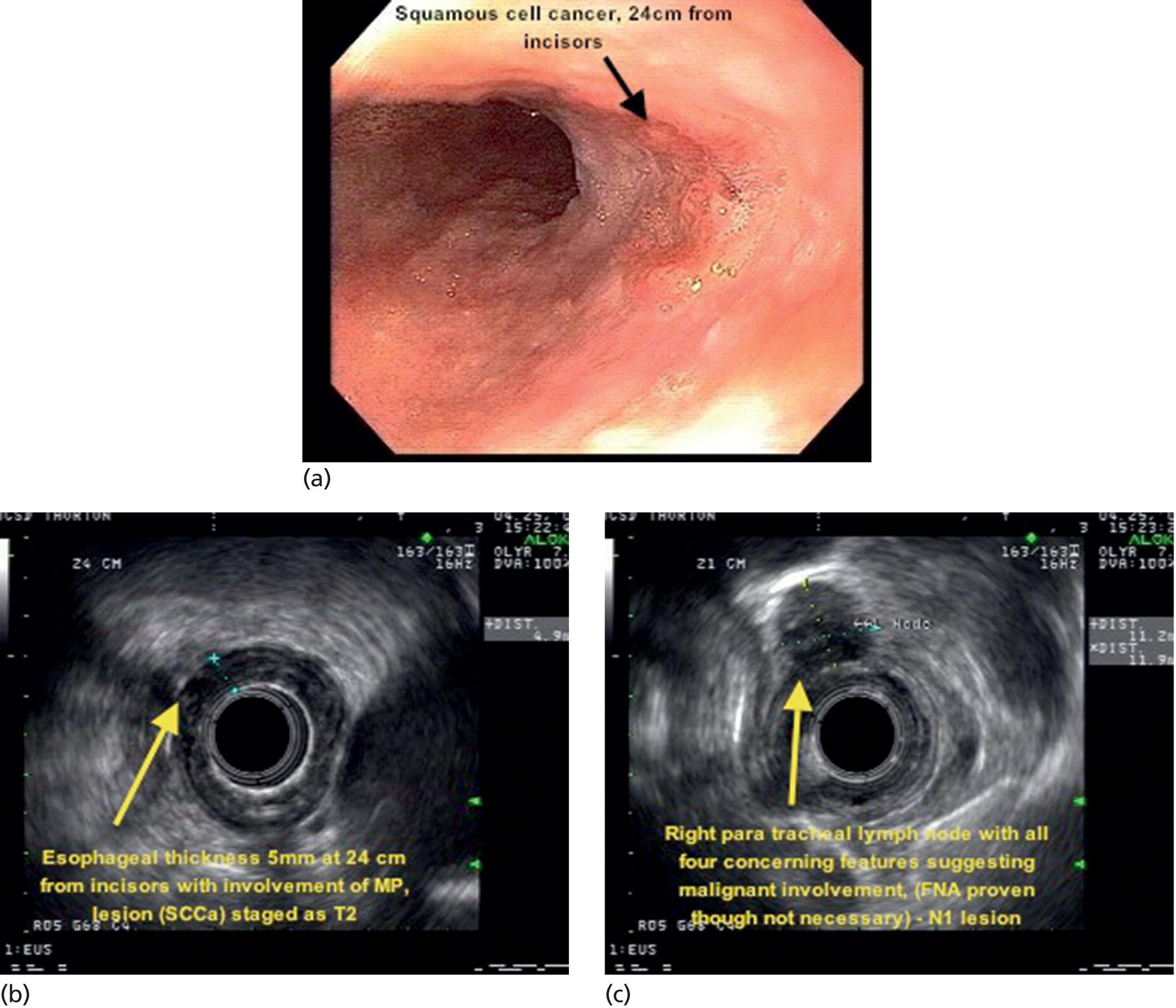 Photos depict (a) T2N1Mx lesion, squamous cell cancer with ulceration 24 cm from incisors shown by yellow arrow. (b) EUS image showing invasion of muscularis propria (MP) but not through the MP, shown by arrow. (c) Malignant-appearing paratracheal lymph node also observed and marked by arrow.