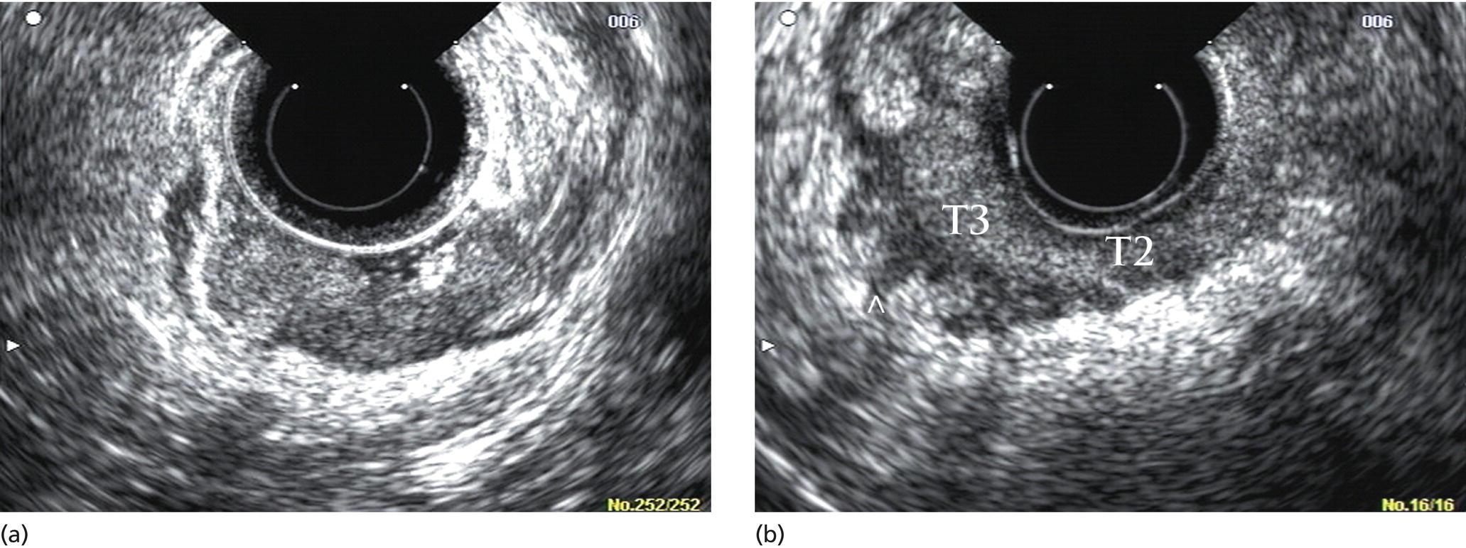 Photos depict (a) A rectal adenocarcinoma that appears to be T2. (b) Radial EUS image of a rectal adenocarcinoma that appears to be T2 in one portion and T3 in another.