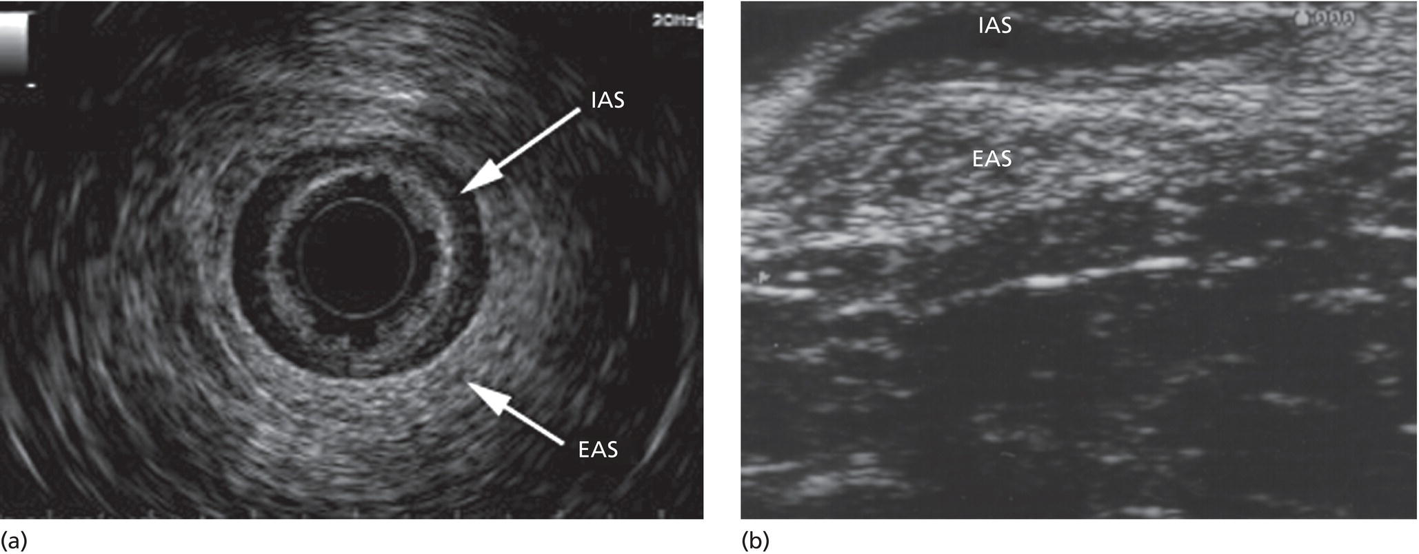 Anal Sphincter Disease Radiology Key 