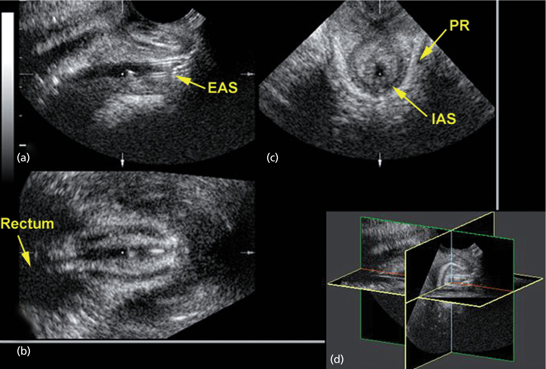 Anal Sphincter Disease Radiology Key 1324