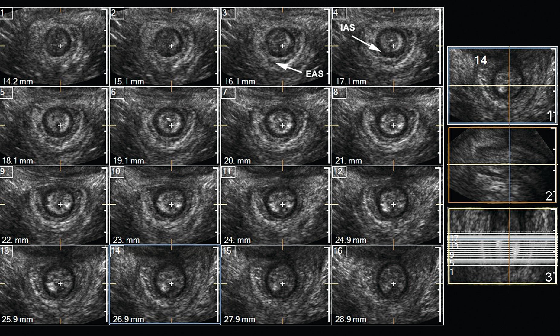 Anal Sphincter Disease Radiology Key 2468