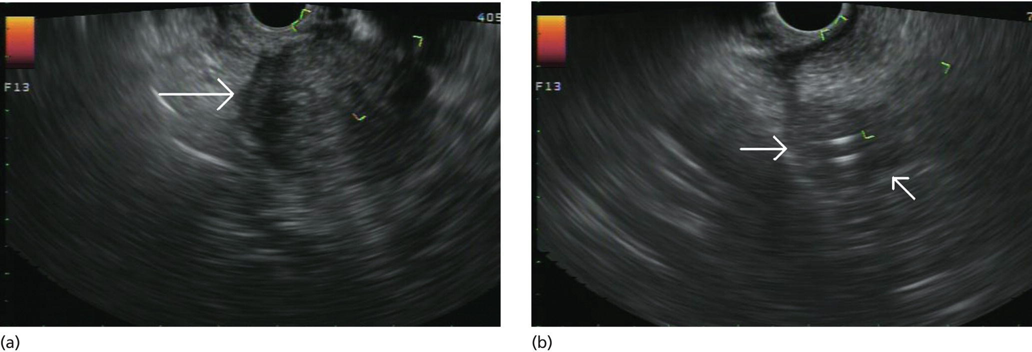 Photos depict (a) Representative EUS image of a large pancreatic adenocarcinoma (arrow). (b) Representative EUS image of a small pancreatic adenocarcinoma (arrows).