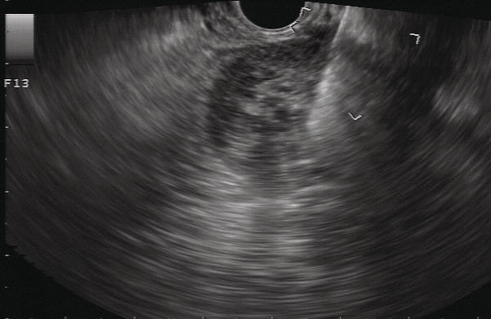 Photo depicts EUS-guided FNA of a pancreatic adenocarcinoma with a 22-gauge needle.