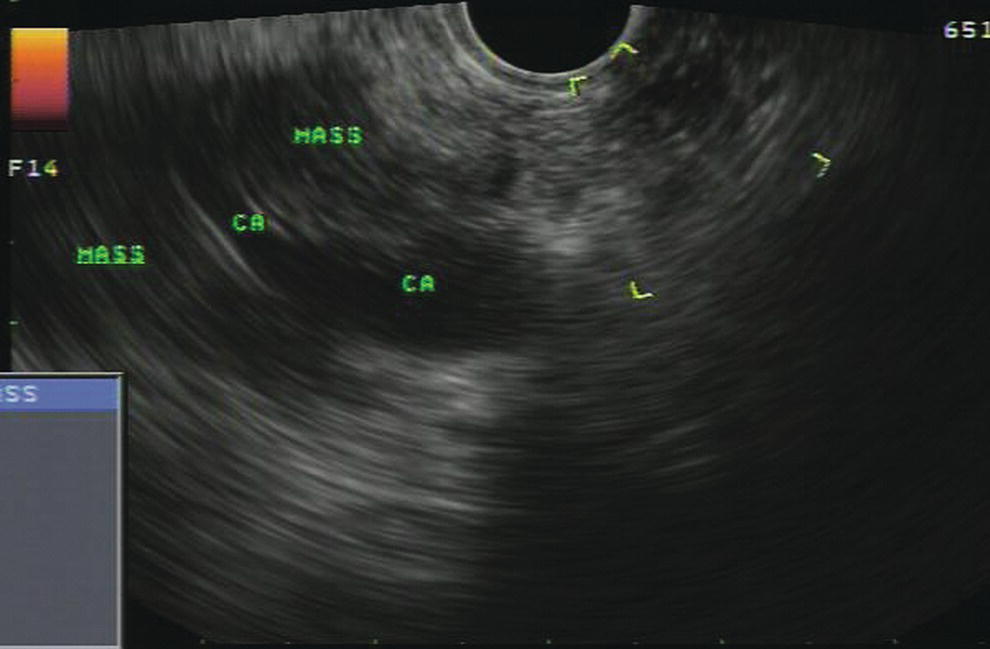 Photo depicts EUS image of a pancreatic adenocarcinoma in the body of the pancreas encasing the celiac artery (CA).